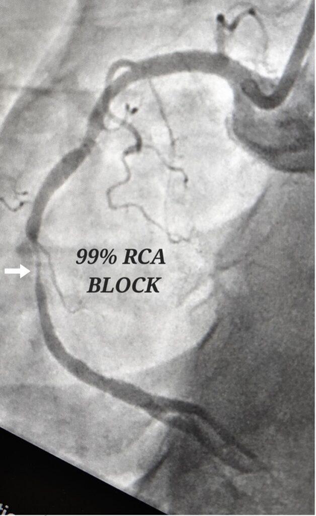 99Percent RCA Block