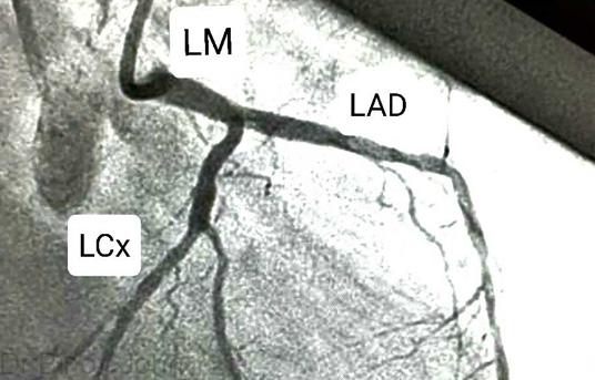Coronary Angiogram