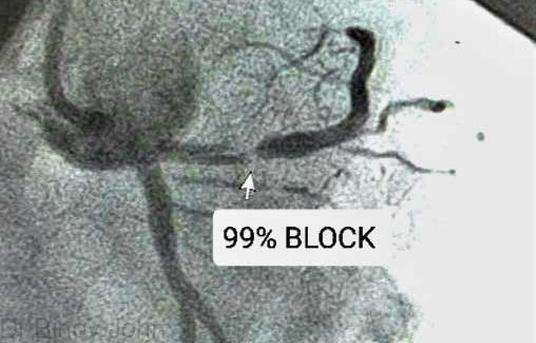 What Is Angioplasty?