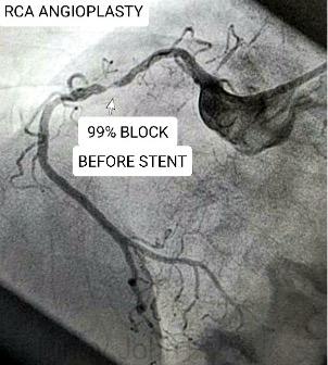 RCA with 99% block
