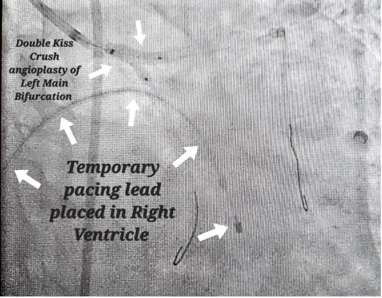 Permanent Pacemaker Implantation (PPI) – Dr Binoy John