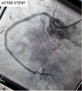 An excellent result and blood flow are achieved after stent deployment