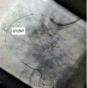 Stent is positioned across the block and deployed