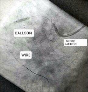 Wire and balloon are positioned in the RCA and the block is opened by inflating the balloon