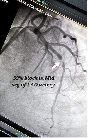 99% block in LAD artery