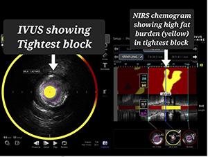 99% block in LAD artery
