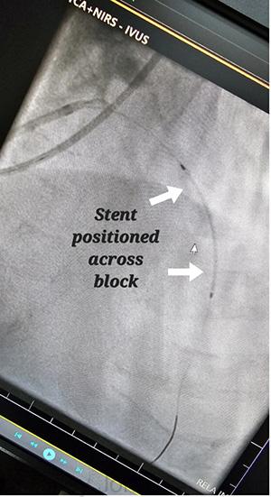 99% block in LAD artery
