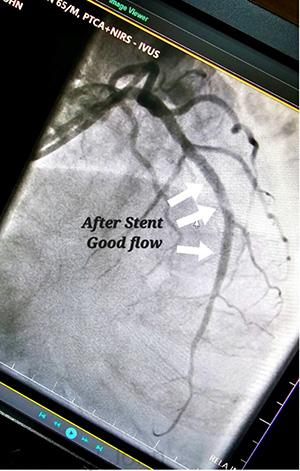 99% block in LAD artery