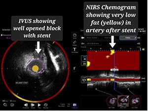 99% block in LAD artery